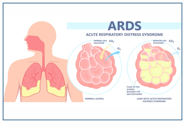 ARDS